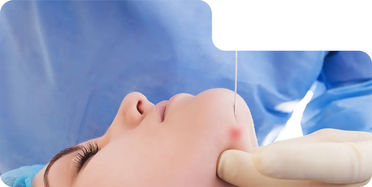 Endolift технологиясы бойынша процедуралар үшін жұмыс аймақтары